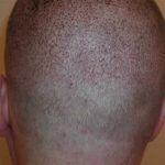 Entnahmestelle der Grafts nach FUE-Haartransplantation am Tag 2