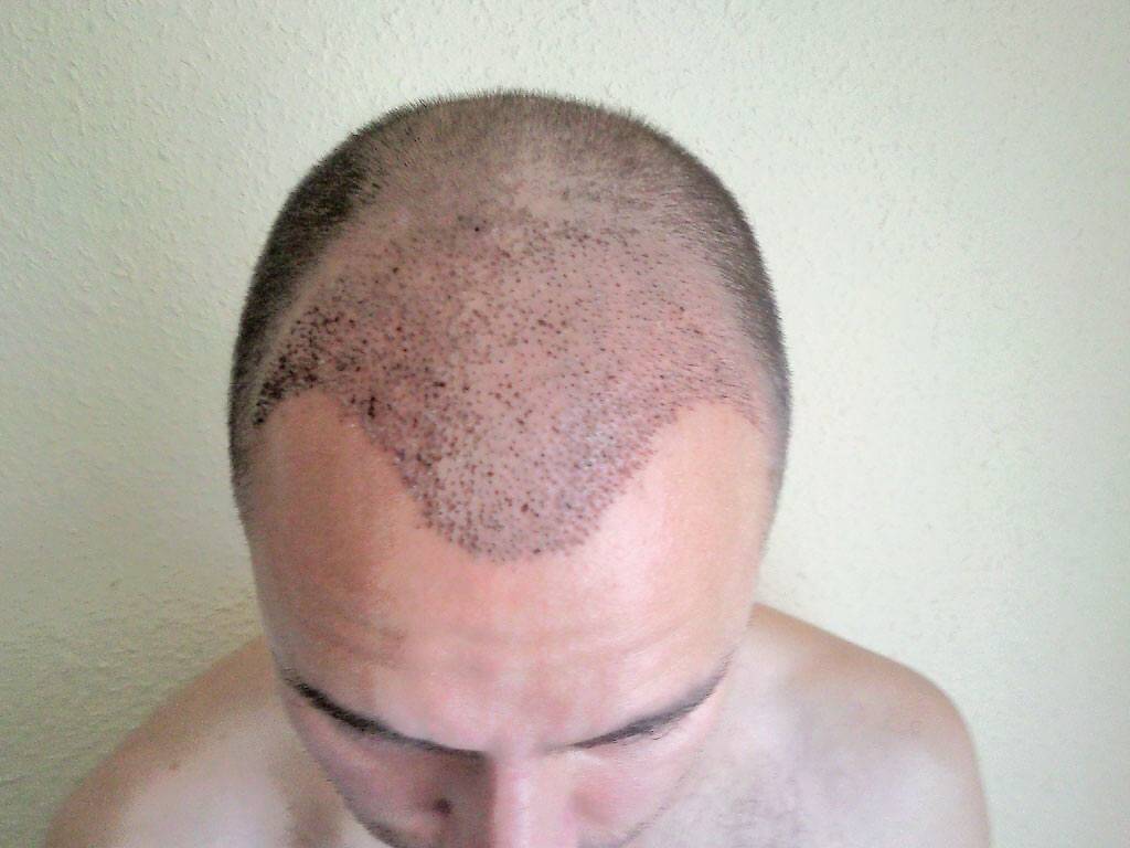 Ansicht von oben nach der Haartransplantation