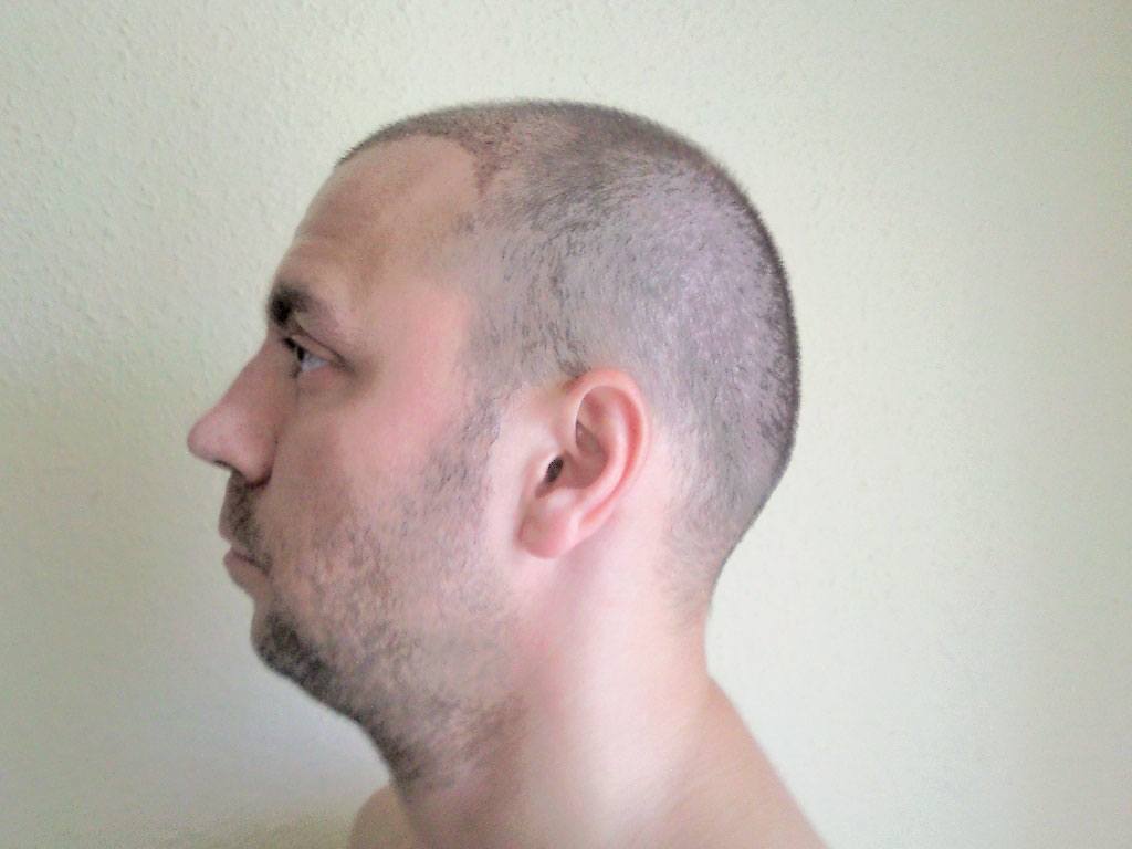 Seitenansicht nach der Haartransplantation