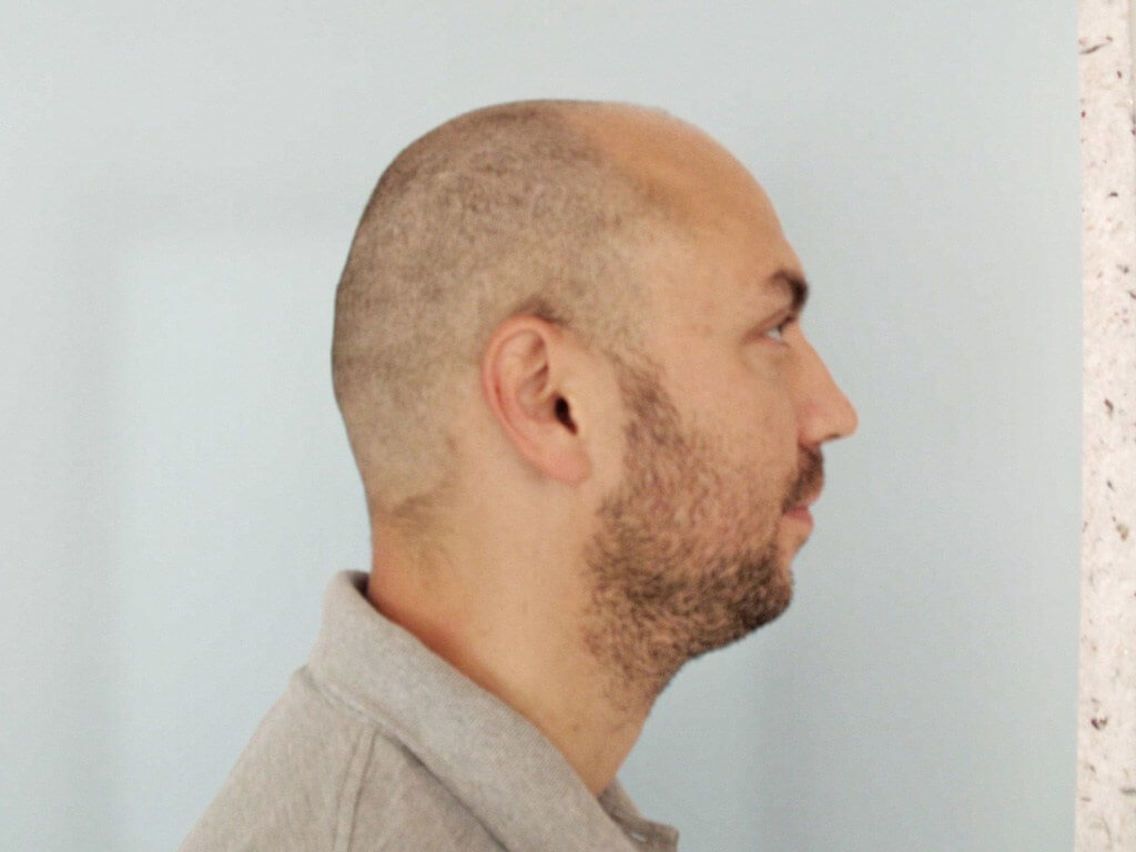 Seitenansicht vor der Haartransplantation