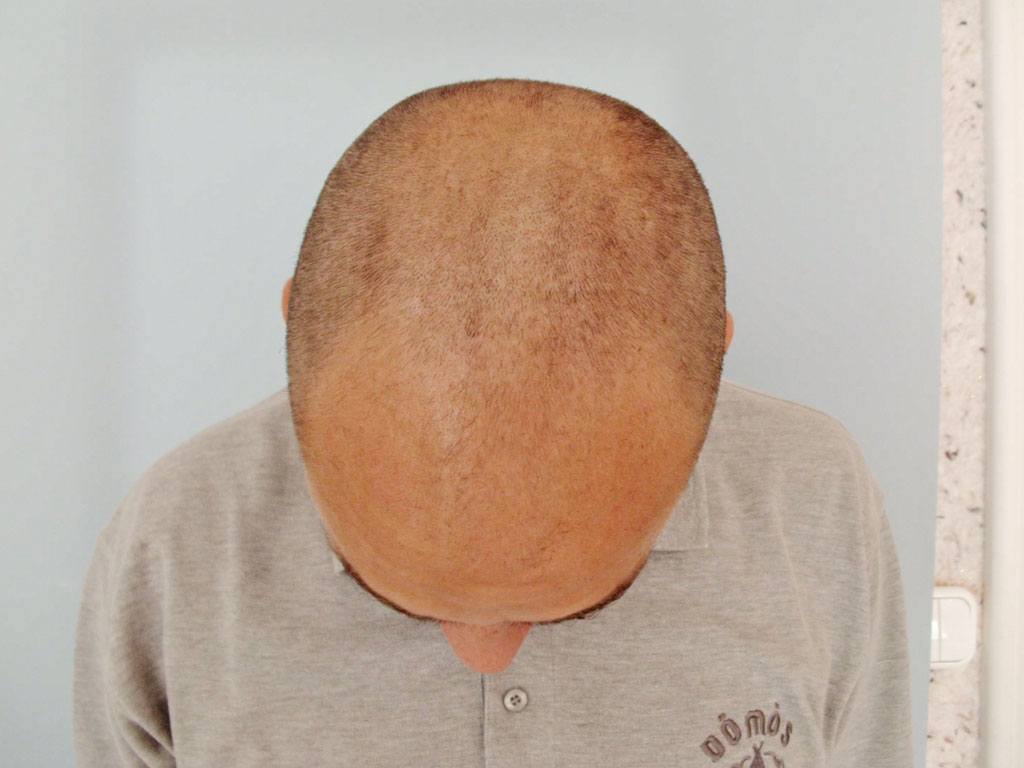 Vor der Haartransplantation