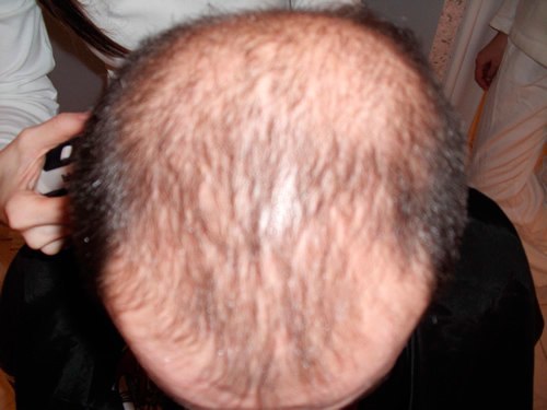 Ansicht von hinten vor der Haartransplantation