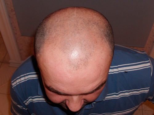 Ansicht von oben vor der Haartransplantation