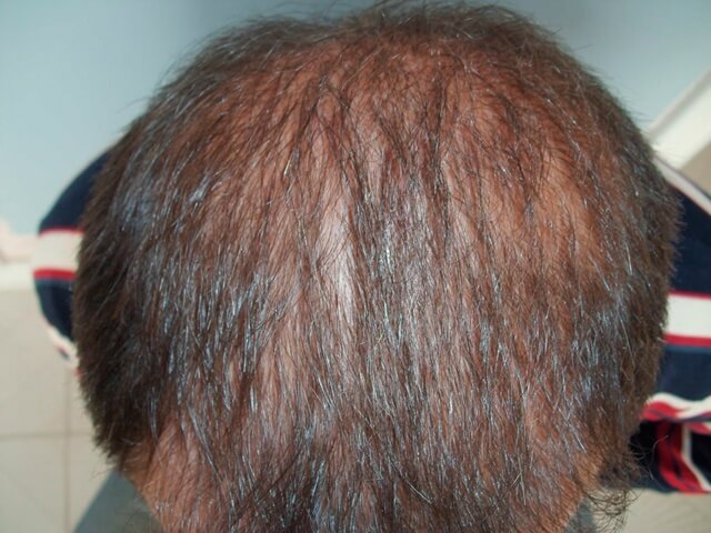 Seitenansicht nach der Haartransplantation