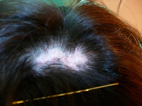 Vor der Haartransplantation