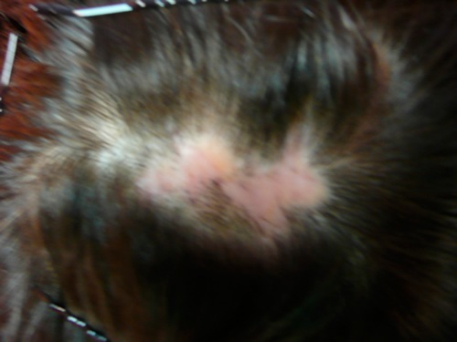 Ansicht von oben vor der Haartransplantation