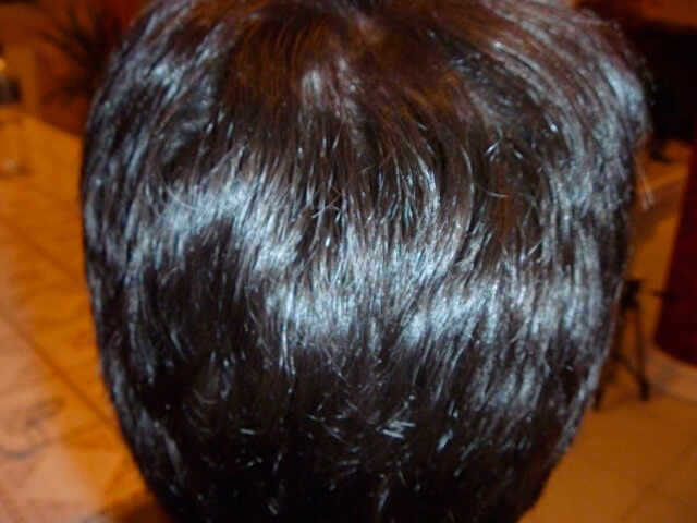 Seitenansicht nach der Haartransplantation