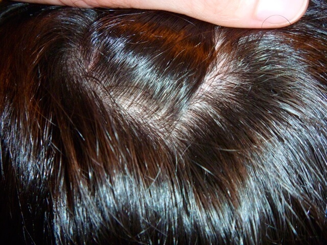 Ansicht von vorne nach der Haartransplantation