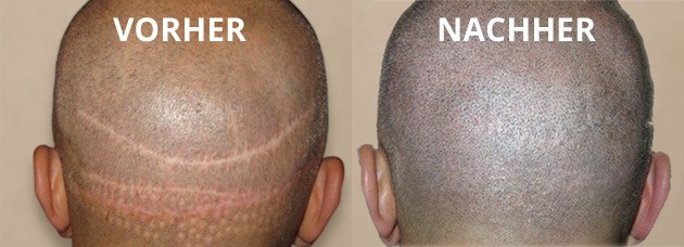 Haartransplantation Narbenentfernung Vorher-Nachher Foto