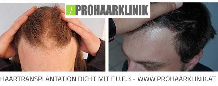 FUE Haartransplantation Bilder