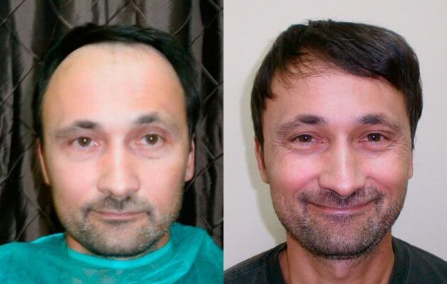 Haare vor und nach der Haartransplantation