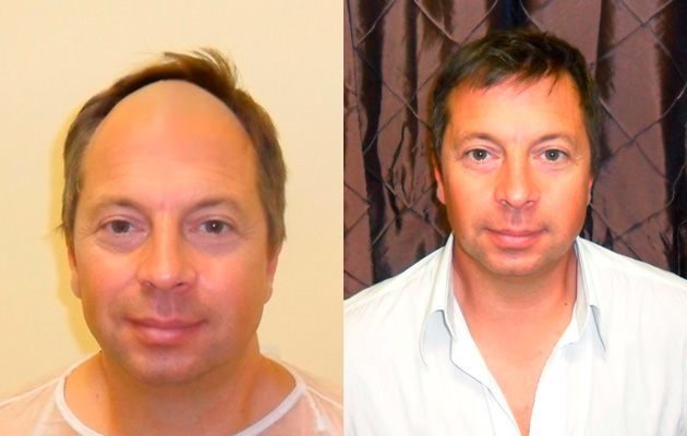 Haartransplantation vorher nachher