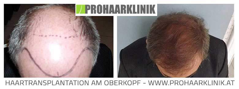 Haartransplantation - PROHAARKLINIK