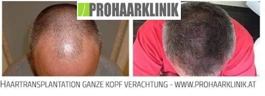 Haartransplantation, Haarimplantation nahe Vorarlberg