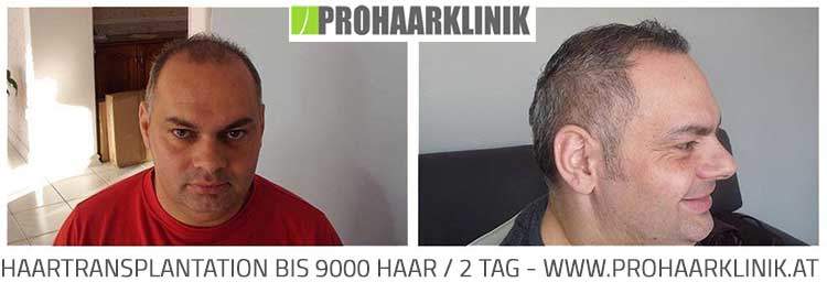 Haartransplantation BIS 9000 Haar