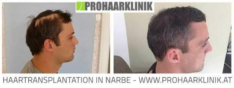 FUE Haartransplantation Vorher Nachher