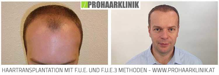 FUE Haartransplantation mit FUE