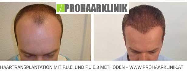 FUE Haartransplantation St. Pölten