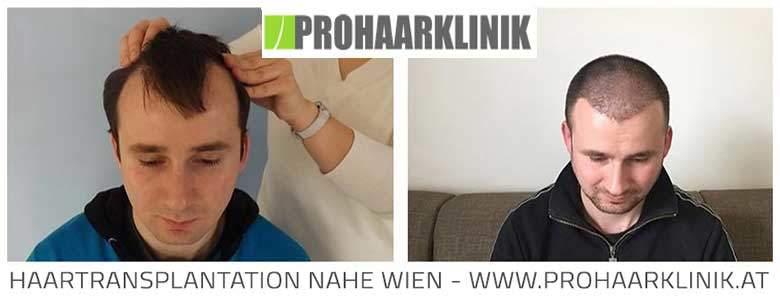 Haartransplantation Vorher Nachher- nahe Wien