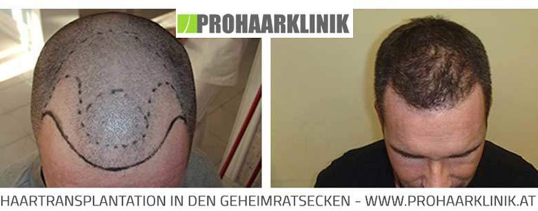 Haartransplantation, Haarverpflanzung vorher nachher