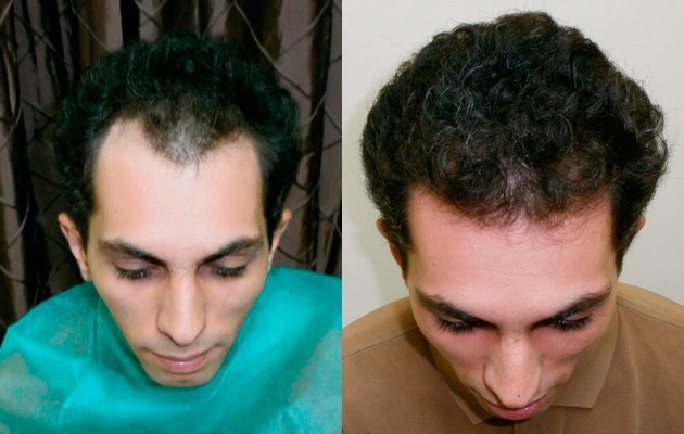 Haare vor und nach der Haartransplantation