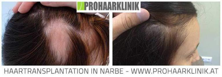 Haartransplantation Schweiz