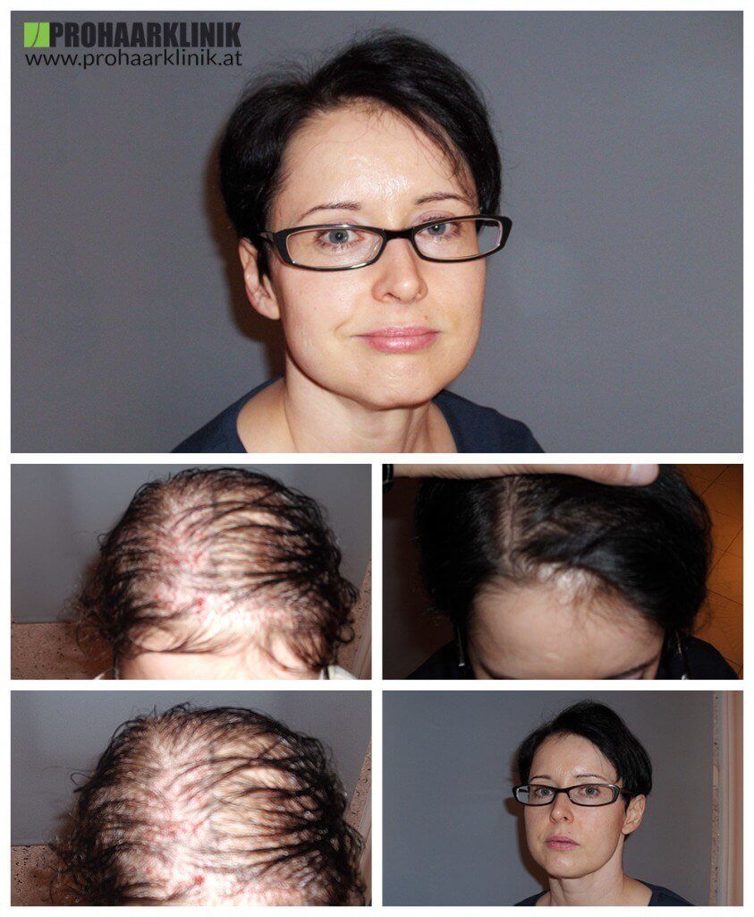 Haartransplantation Glarus Frauen vohrer nachher Haarverpflanzung