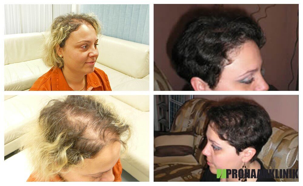 Haartransplantation Vorher-Nachher Fotos Ergebnisse