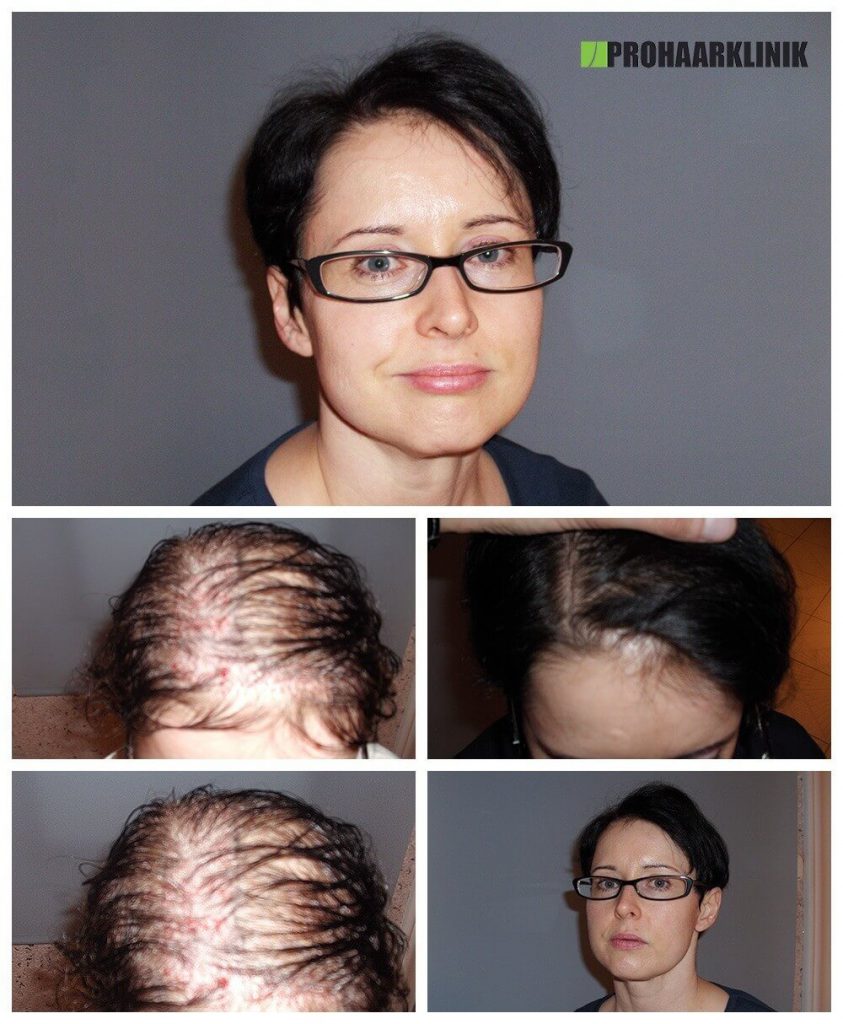 Haartransplantation Vorher-Nachher Fotos Ergebnisse