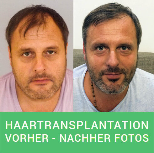 PROHAARKLINIK Haartransplantation Vorher Nachher Fotos