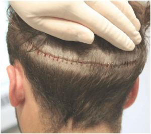 Fehler bei der Haartransplantation